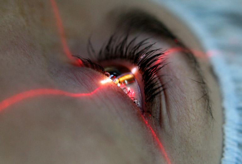 Лазерная операция на глазах