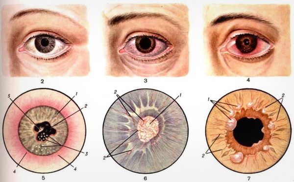 Иридоциклит левого глаза лечение thumbnail