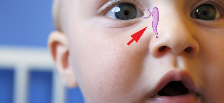 Симптомы непроходимости носослезного канала у новорожденного