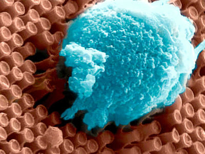 Nanoimplantant-vosstanovlenie-zrenija