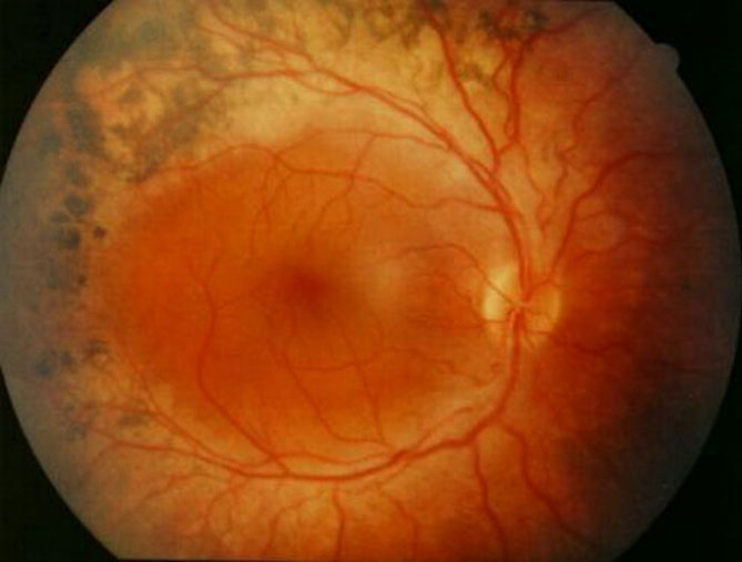 Pigmentnyj retinit