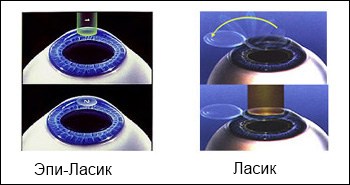 эпи-ласик