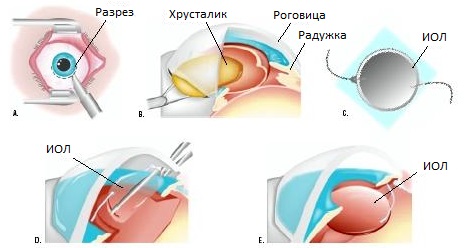 Экстракапсулярная экстракция