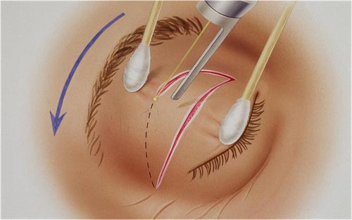 лазерная блефаропластика