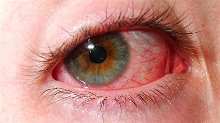 Лечение воспалительных заболеваний глаз