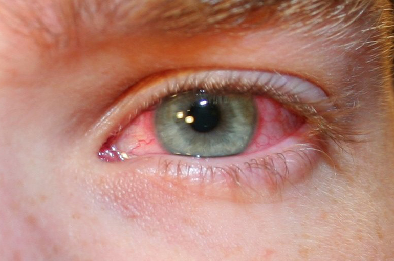 Красные глаза: причины, болезни, лечение