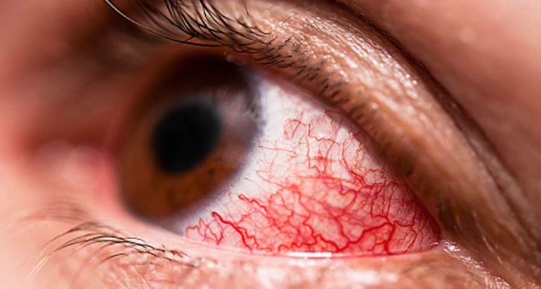 Каковы могут быть причины покраснения глаз?