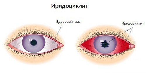 Иридоциклит глаза, схема